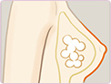 副乳切除