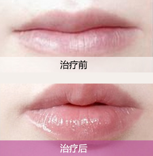 注射丰丰唇