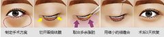 针对不同的眼袋采取不同的祛眼袋方法