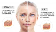 极限音波拉提如何拯救变老的皮肤