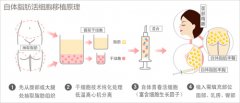 你应该知道的自体脂肪填充重要步骤