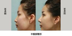 淄博向东玻尿酸满分塑形，打造专属完美轮廓