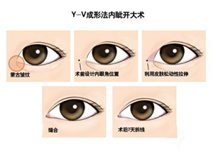 开眼角