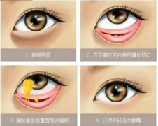 祛眼袋手术要多少钱？