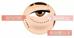 激光祛黑眼圈效果怎么样