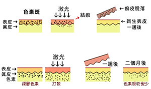 祛黄褐斑