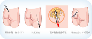 大腿吸脂