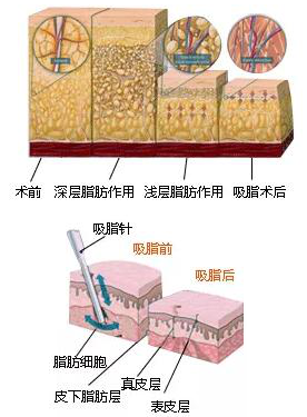 大腿吸脂