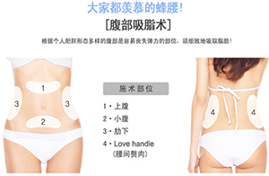 腰腹吸脂