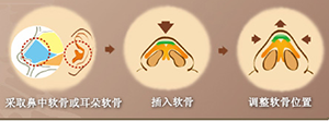 自体软骨隆鼻