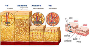 腰腹环吸