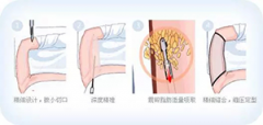 淄博手臂吸脂怎么样？
