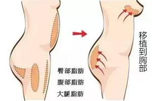自体脂肪丰胸