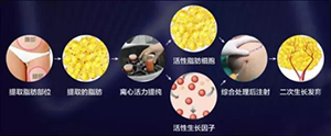 自体脂肪丰胸
