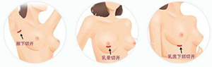 假体隆胸