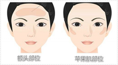 淄博自体脂肪丰苹果肌多少钱