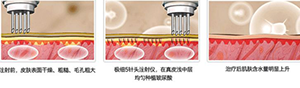 水光针美白