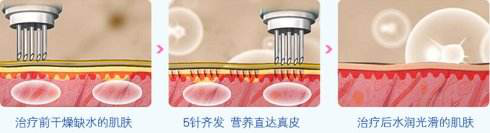 水光针美白