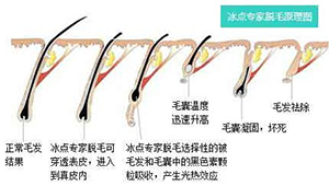 脱毛
