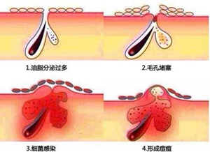青春痘