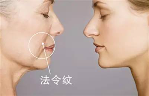 法令纹