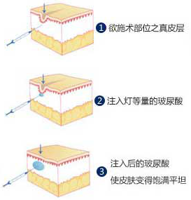 祛鱼尾纹