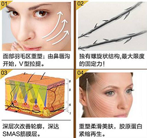 线雕
